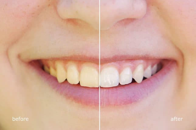Before and after teeth whitening treatment