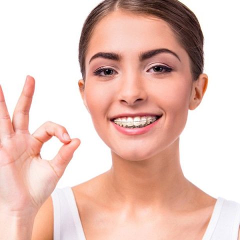Clear Aligners