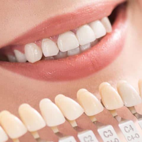 Benefits of Porcelain Veneers