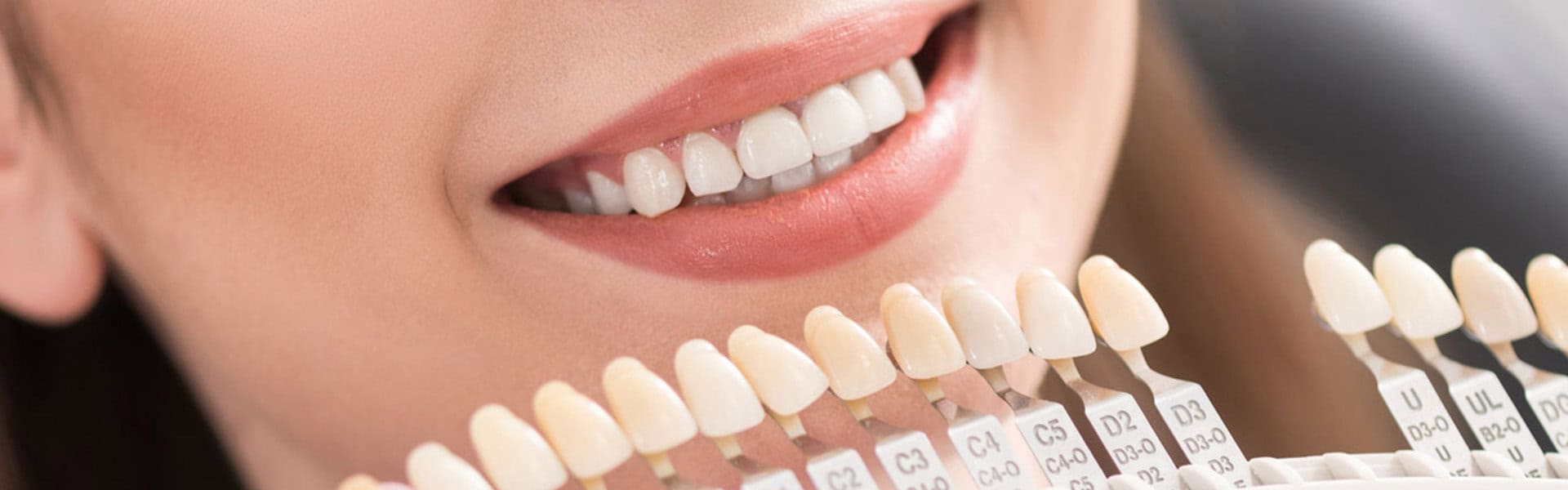 What Can Porcelain Veneers Fix? A Smile 4 U