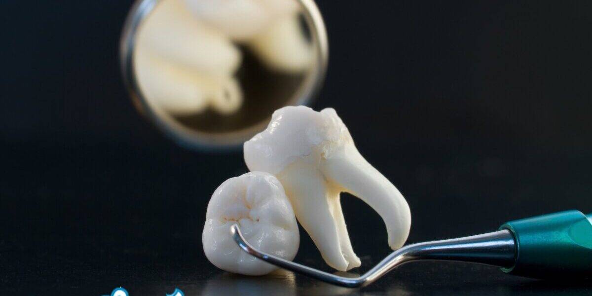 A wisdom tooth
