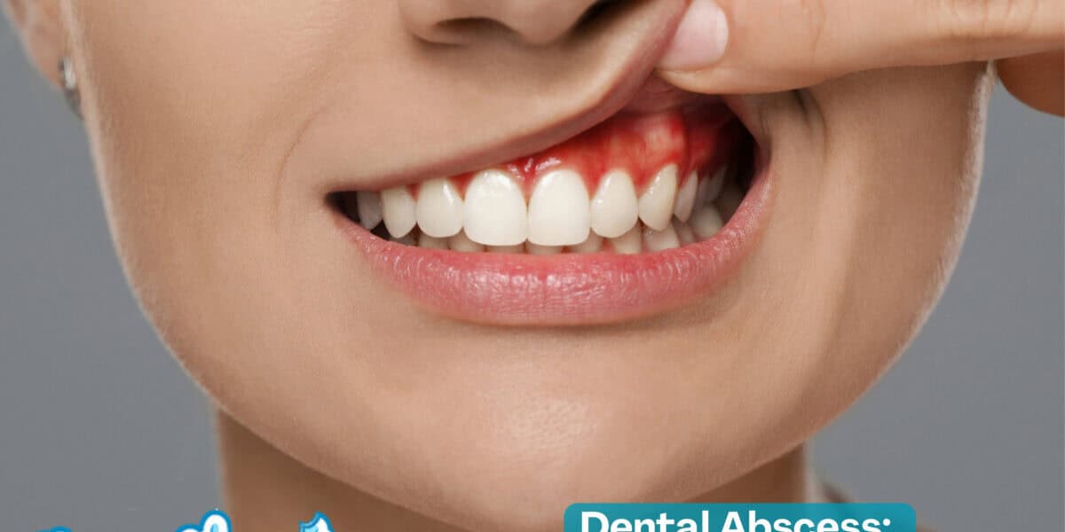 Dental Abscess: How to Drain a Dental Abscess? Wisdom Tooth Abscess Dental Abscess: How to Drain a Dental Abscess? Wisdom Tooth Abscess