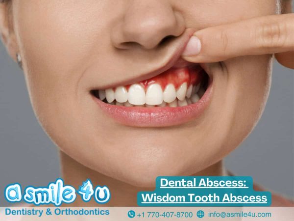 Dental Abscess: How to Drain a Dental Abscess? Wisdom Tooth Abscess Dental Abscess: How to Drain a Dental Abscess? Wisdom Tooth Abscess