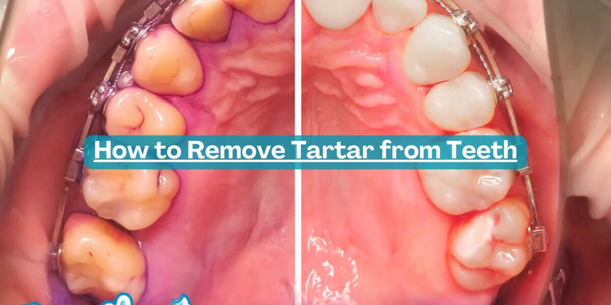 How to Remove Tartar from Teeth at the Dentist