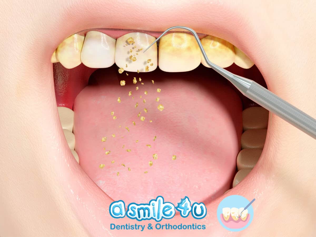 How to Remove Tartar from Teeth at the Dentist