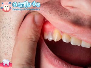 Dental Abscess: How to Drain a Dental Abscess? Wisdom Tooth Abscess