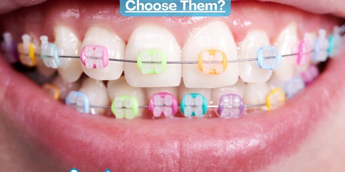 Braces Colors : Why Is It Important to Choose Them? Braces Colors : Why Is It Important to Choose Them?