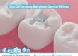 The Difference Between Dental Fillings