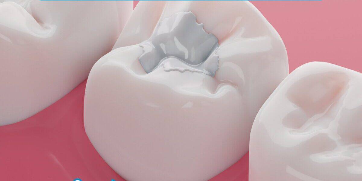 The Difference Between Dental Fillings