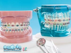 Choosing Braces Colors Based on Personality
