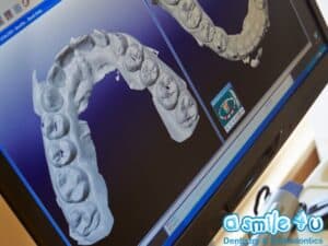 Digital Dental Impressions