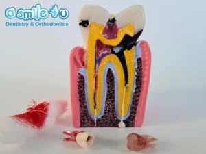 When Should a Tooth Nerve Be Removed?