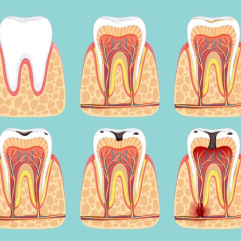 Tooth decay treatment in Decatur GA depends on the tooth decay stage