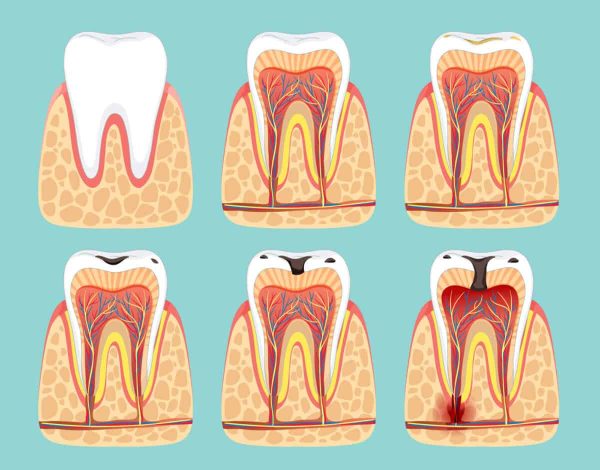 Tooth decay treatment in Decatur GA depends on the tooth decay stage