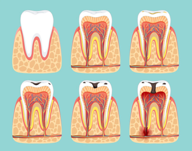 Tooth decay treatment in Decatur GA depends on the tooth decay stage