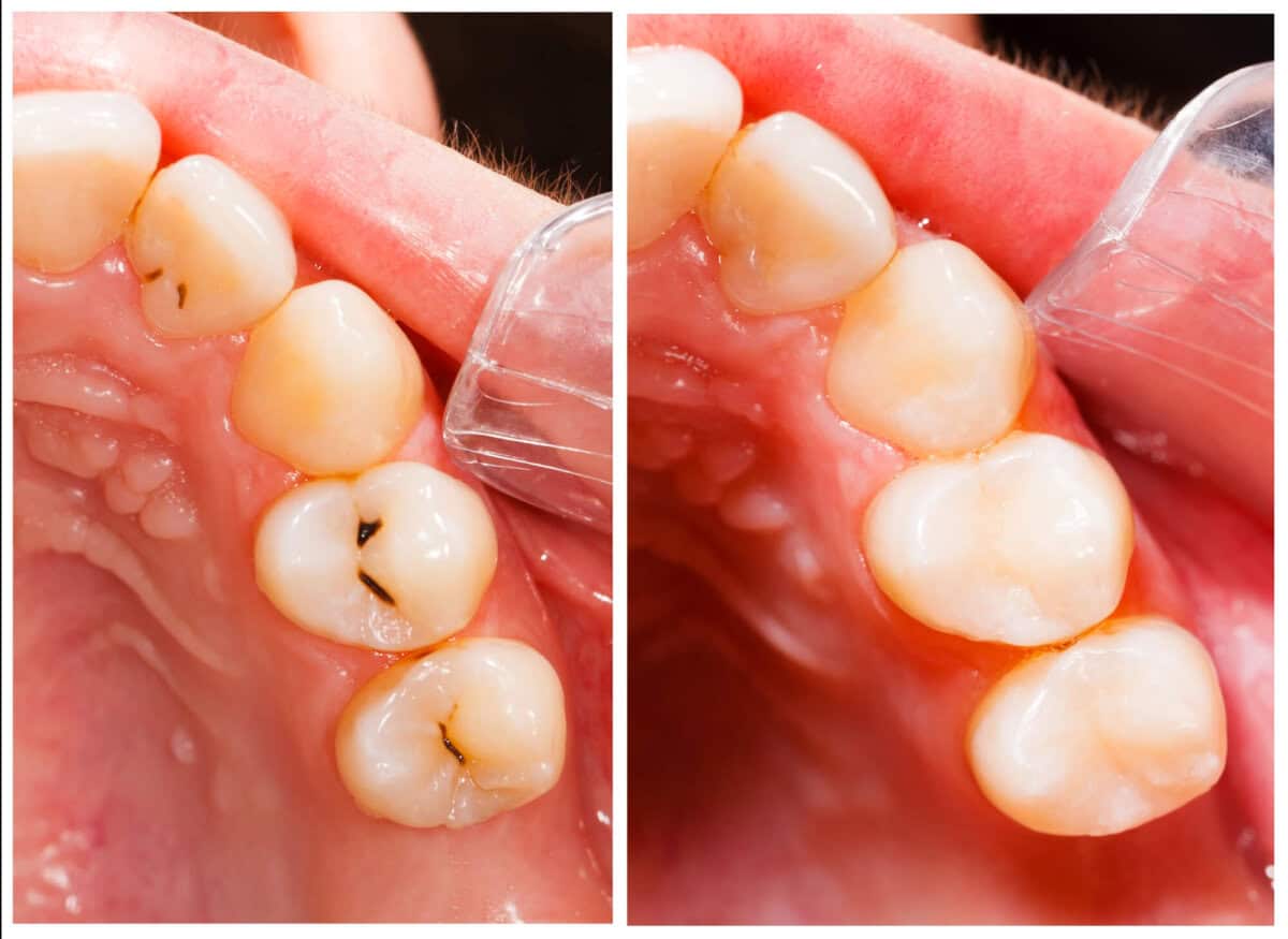 before and after comprehensive tooth filling services