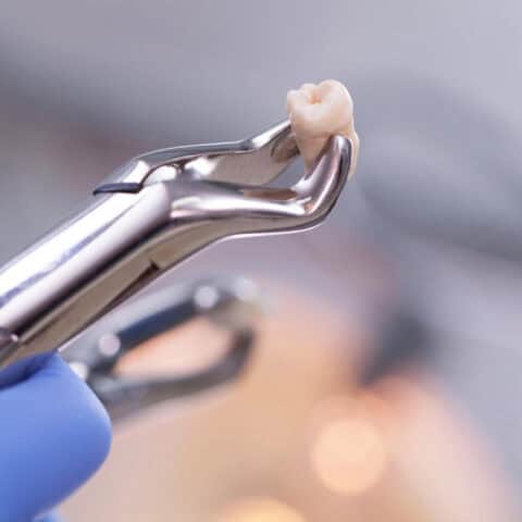 affordable tooth extractions near me