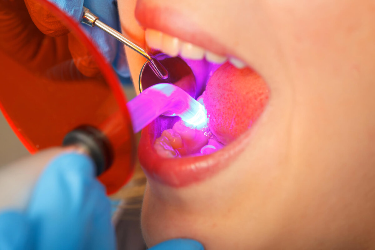Comprehensive Tooth Filling Services