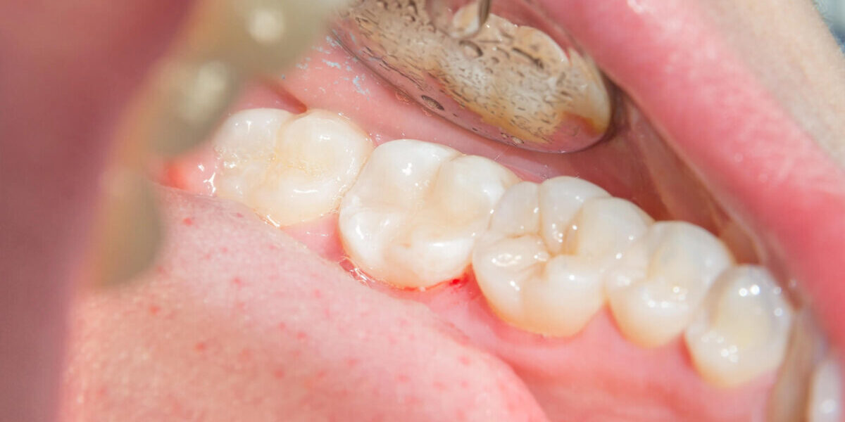 after-Comprehensive-Tooth-Filling-Services after Comprehensive Tooth Filling Services