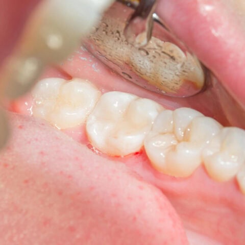 after Comprehensive Tooth Filling Services