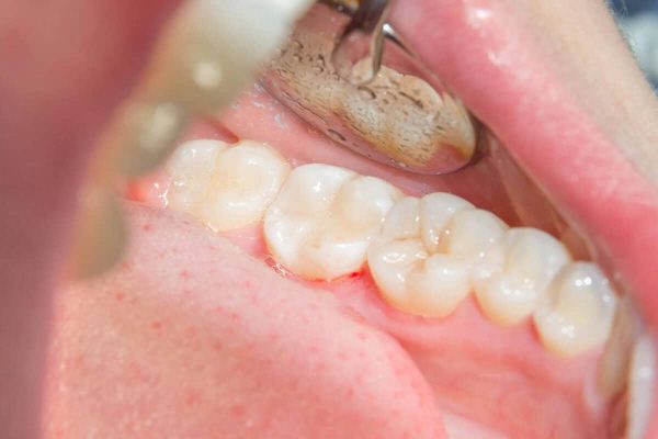 after-Comprehensive-Tooth-Filling-Services after Comprehensive Tooth Filling Services