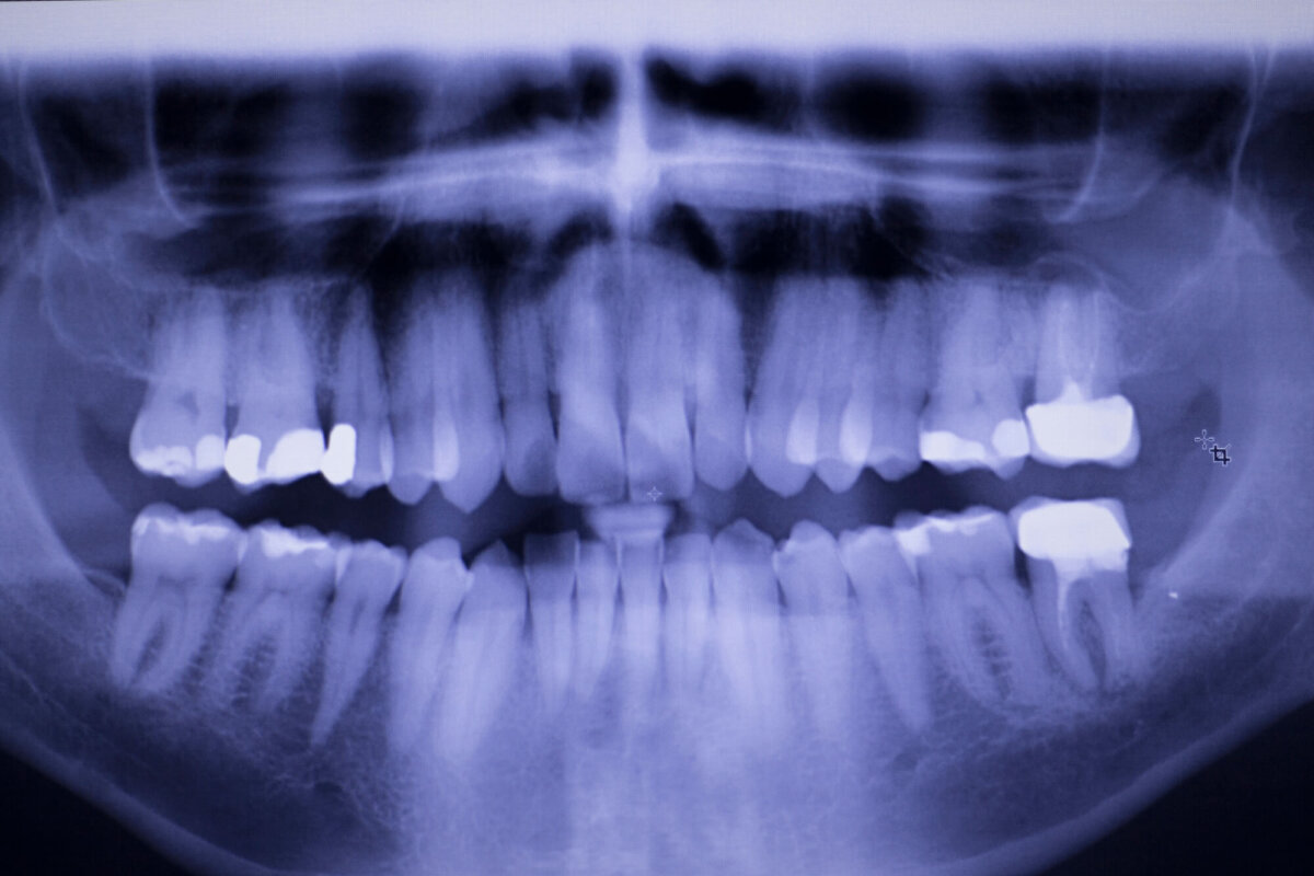 x-rays as a part of Comprehensive Tooth Filling Services