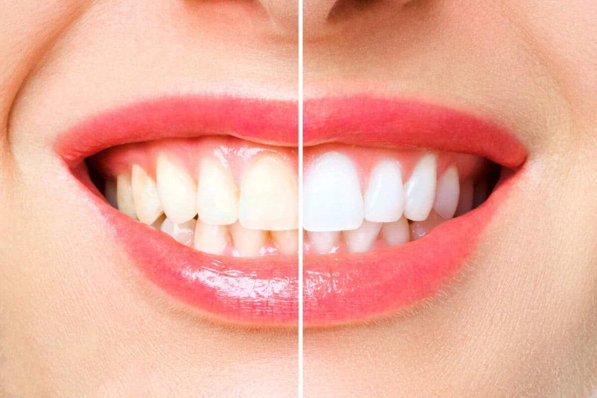 before-and-after-teeth-whitening-and-Affordable-Cosmetic-Dentistry-Dalton-GA