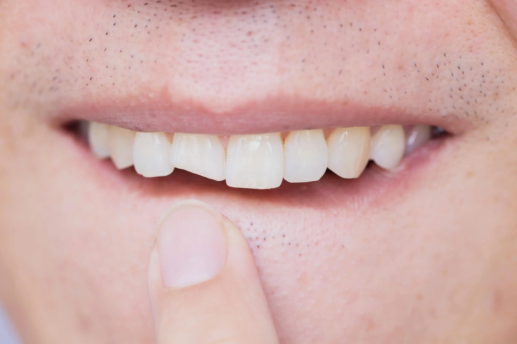 man-needing-Dental-Crowns-in-Dalton-GA 